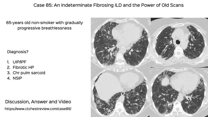 Hypersensitivity Pneumonitis Ct Chest Review