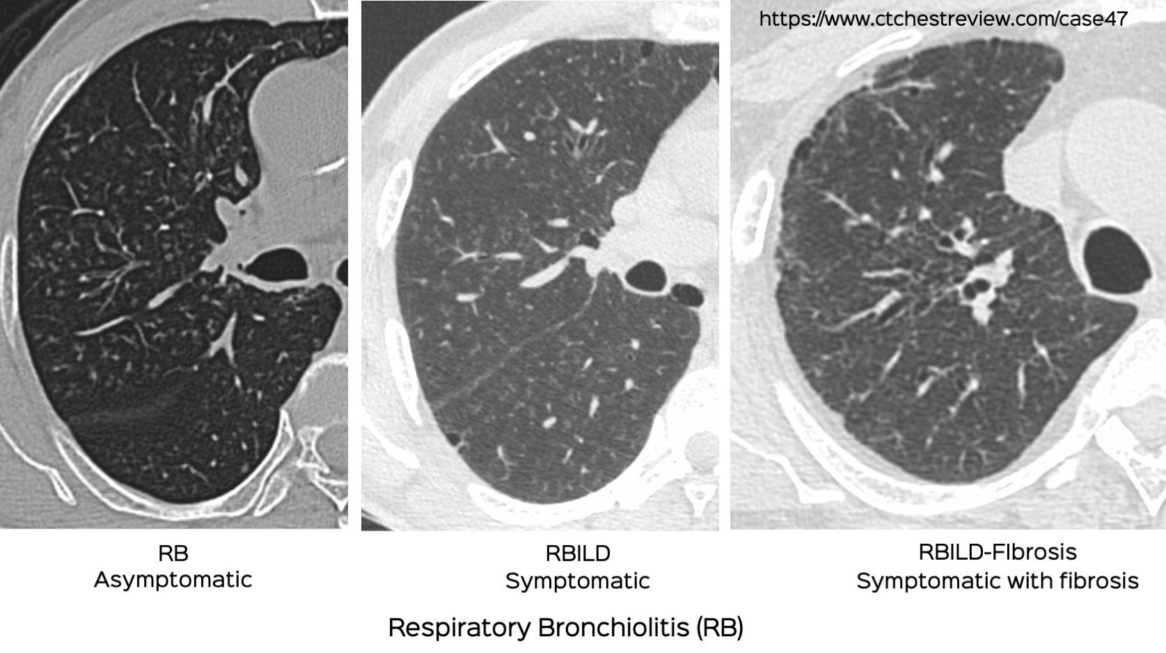 case-47-when-does-rb-become-rbild-and-rbild-fibrosis