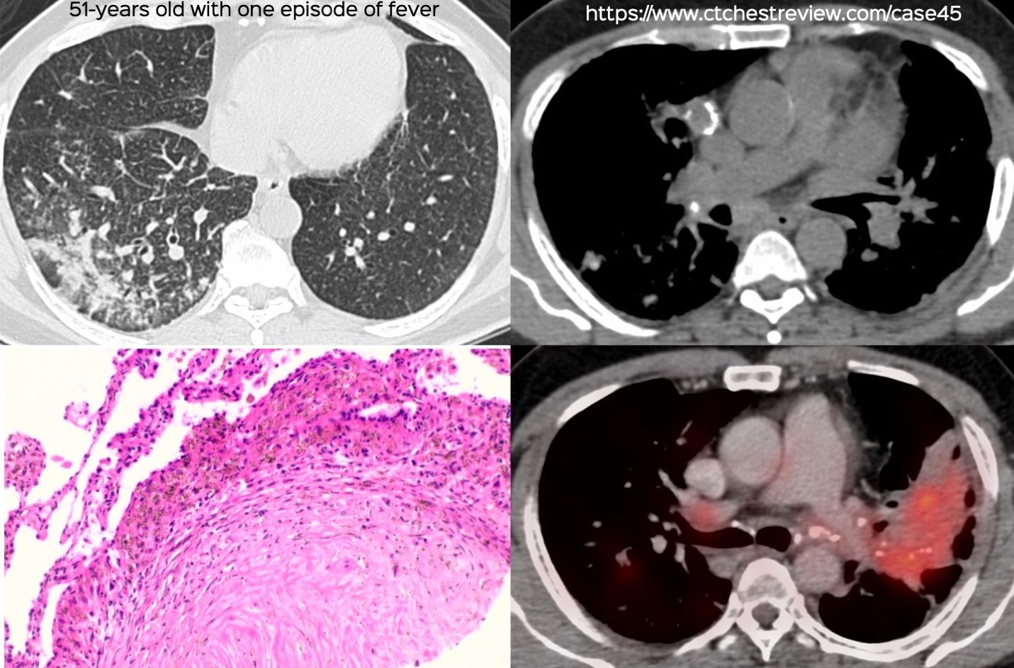 calcified lung adenocarcinoma ct