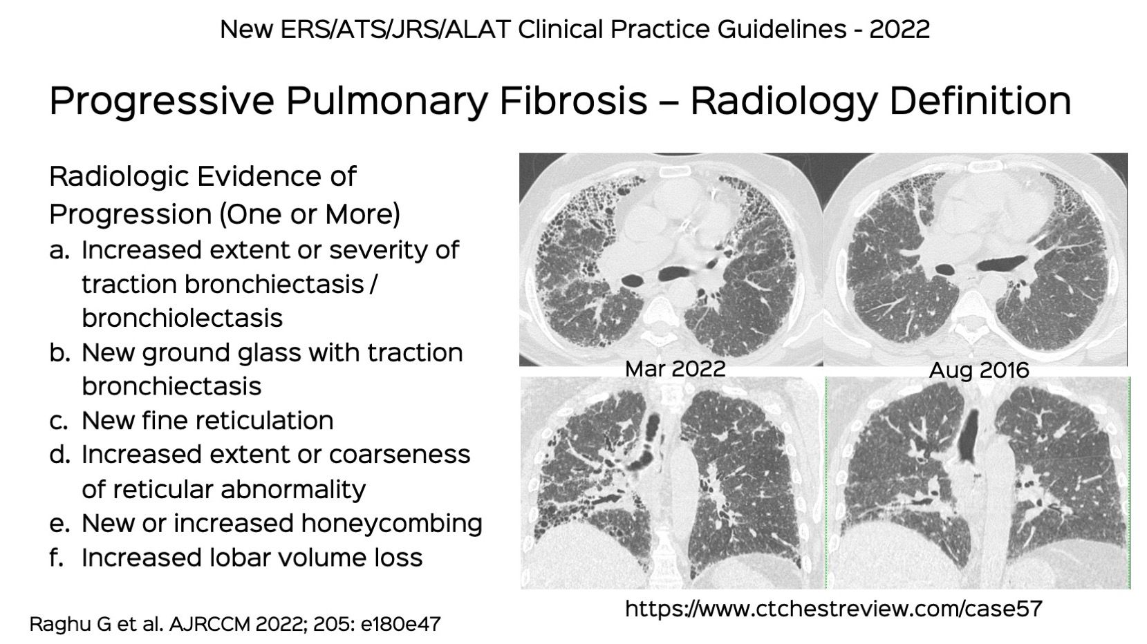 Case Progressive Pulmonary Fibrosis The Ats Ers Jrs Alat Clinical Practice Guidelines