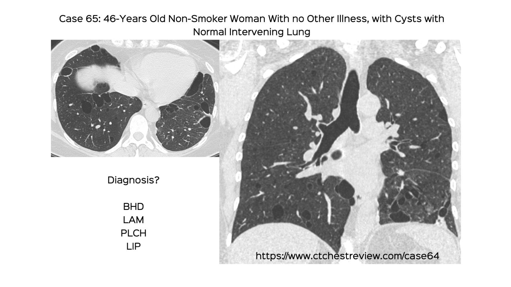 Case 65: This Diffuse Cystic Lung Disease is Not as Rare as You May Think