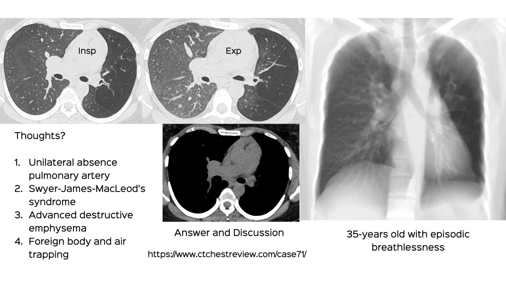 Case 71: Unilateral Lucent Lung