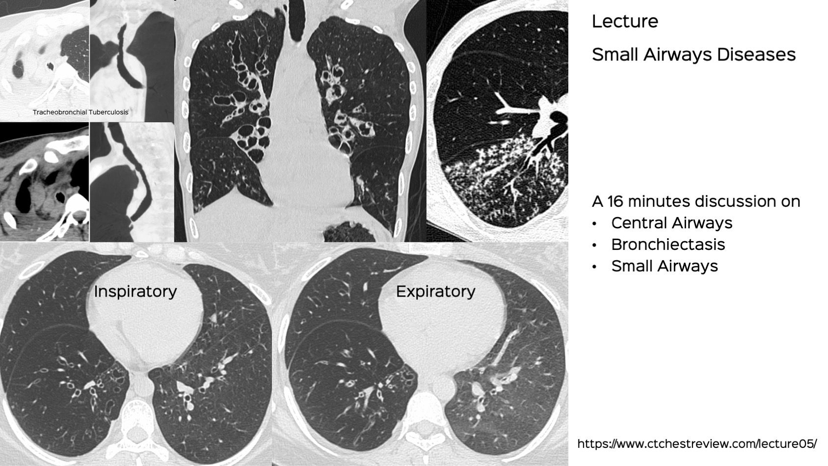 Lecture 05 Airways Diseases