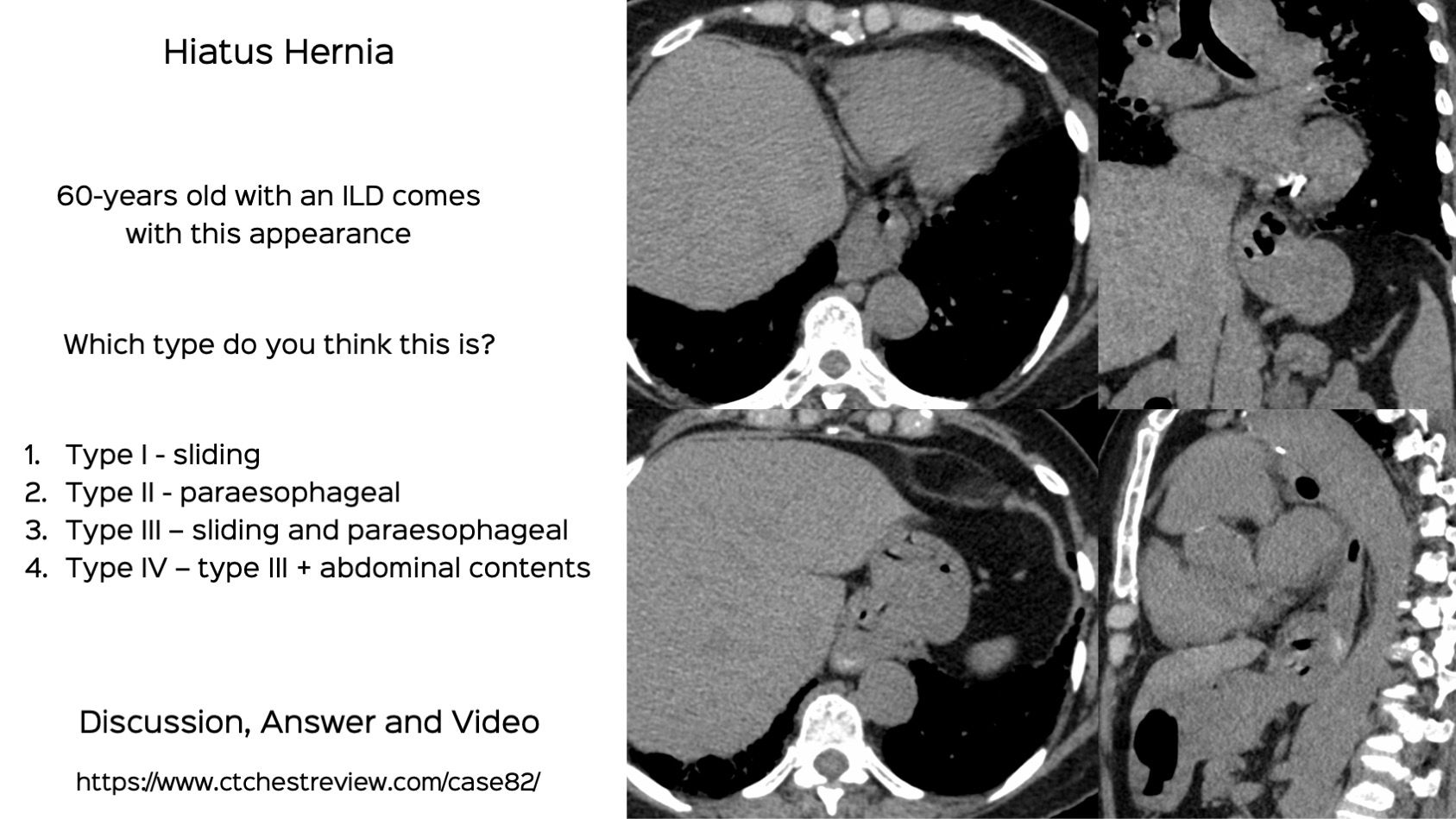 Case 82: Diagnosing Hiatus Hernia and Its Different Types