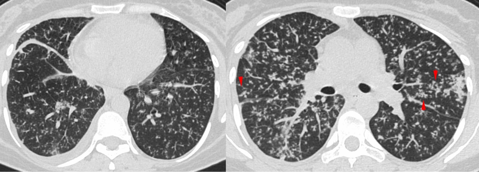 Case 101: When the Pattern of Lung Disease Gives a Clue to the Diagnosis