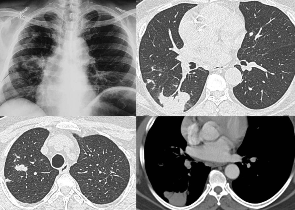 case-21-fungal-infection-in-the-immunocompetent