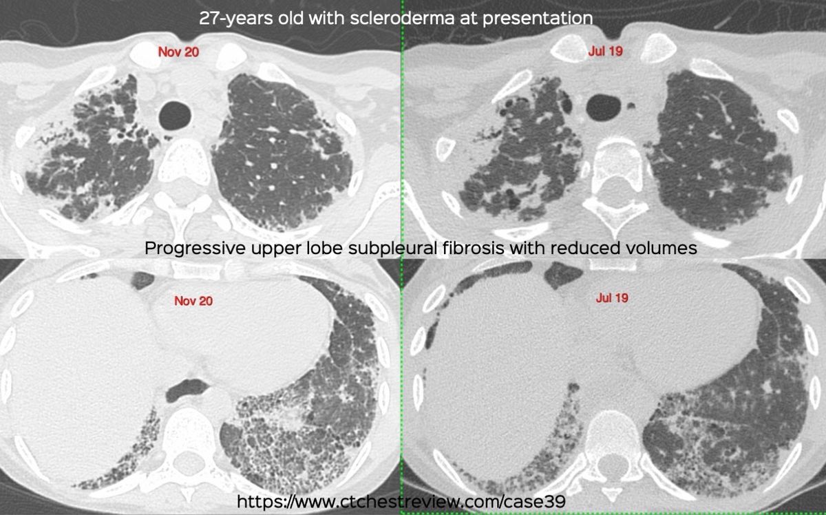 Case 39: Upper Lobe Subpleural Fibrosis