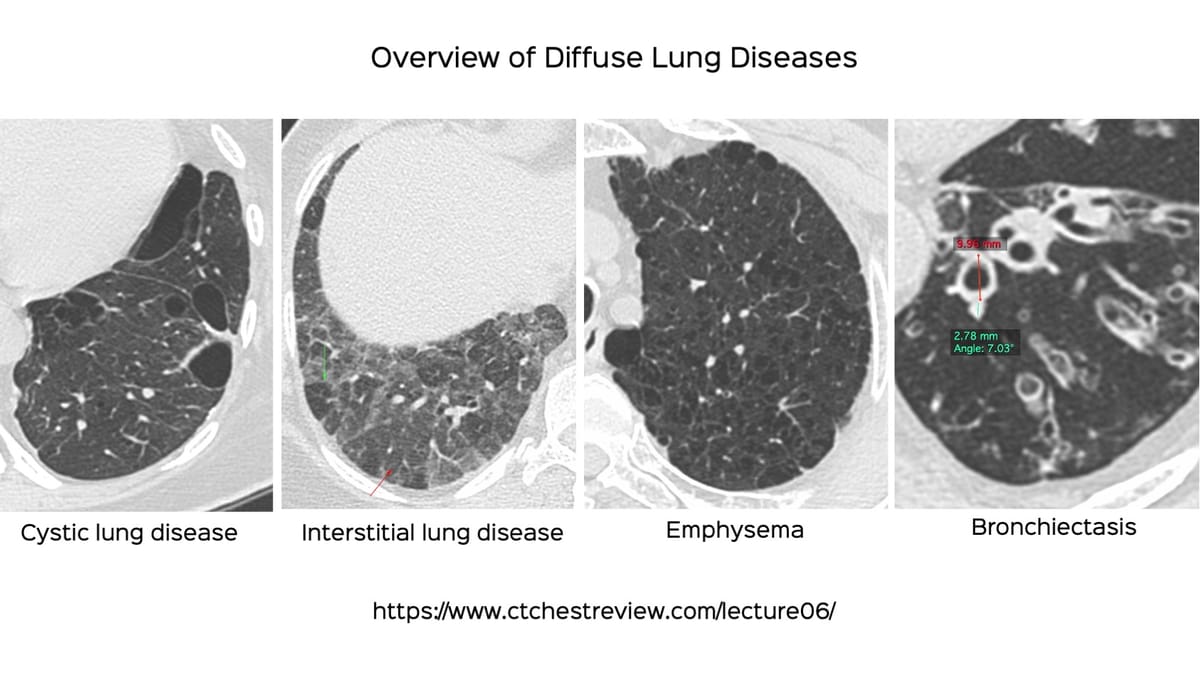 Lecture Overview Of Diffuse Lung Diseases 1765