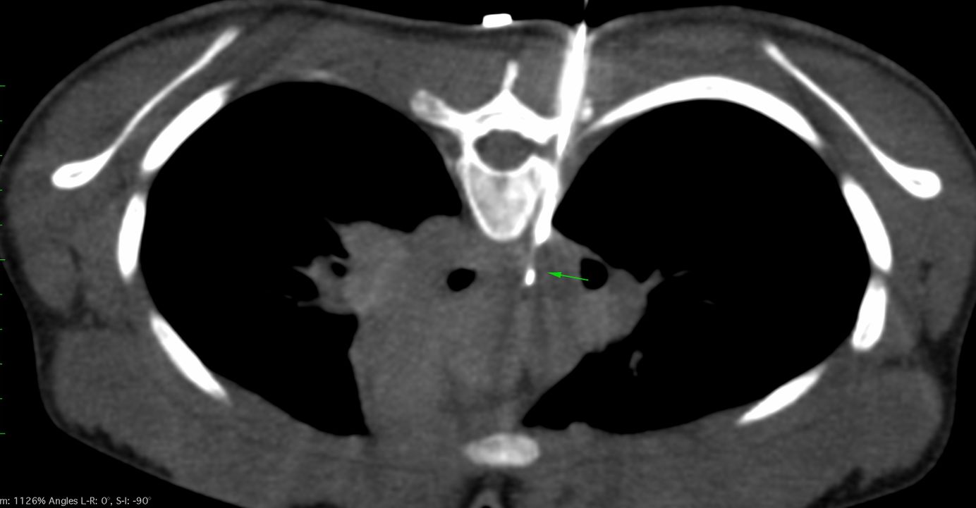 CT Guided Biopsy