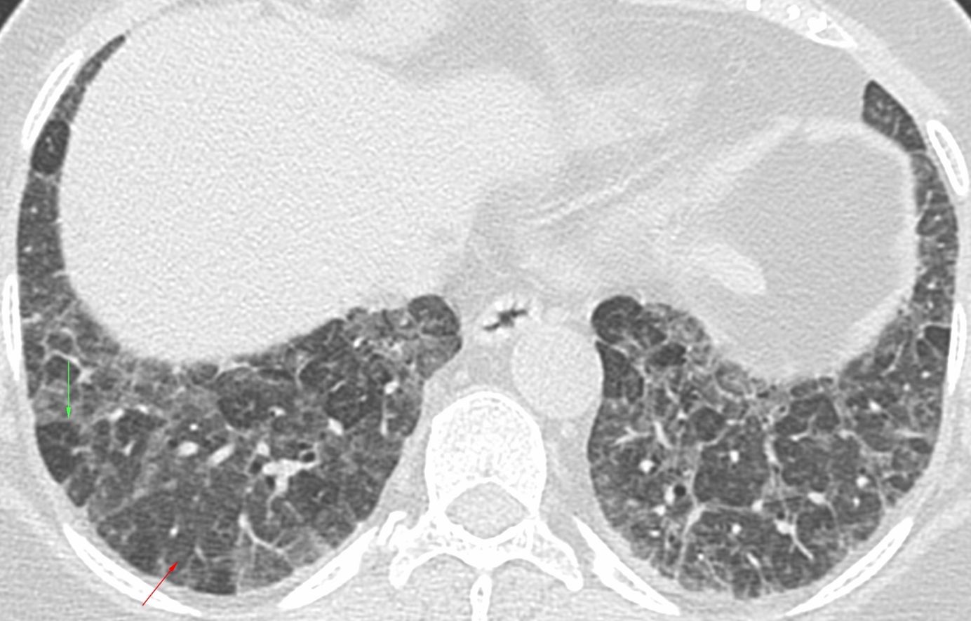 Hypersensitivity Pneumonitis Ct Scan 9397