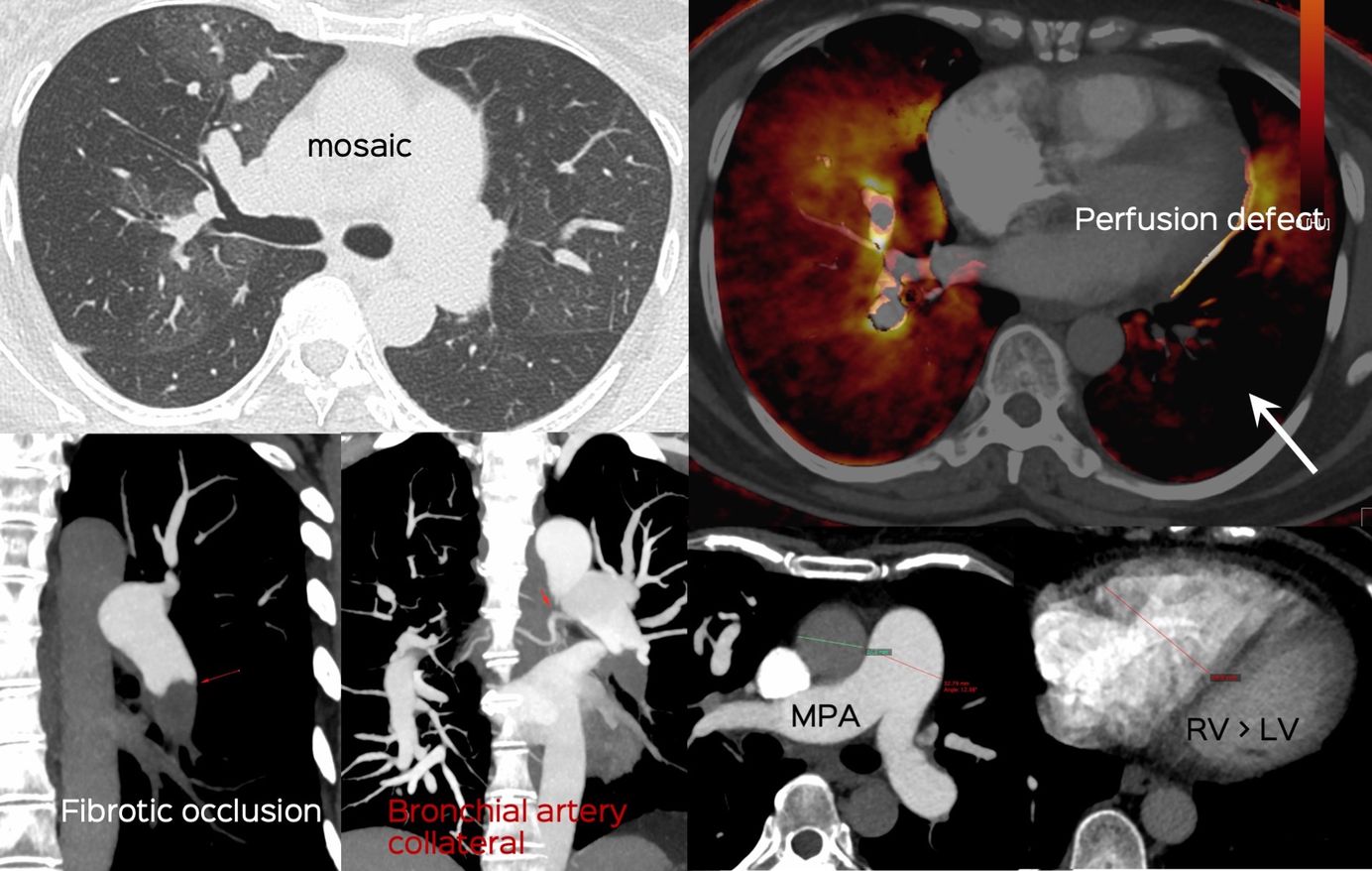 Pulmonary Hypertension CT Chest Review