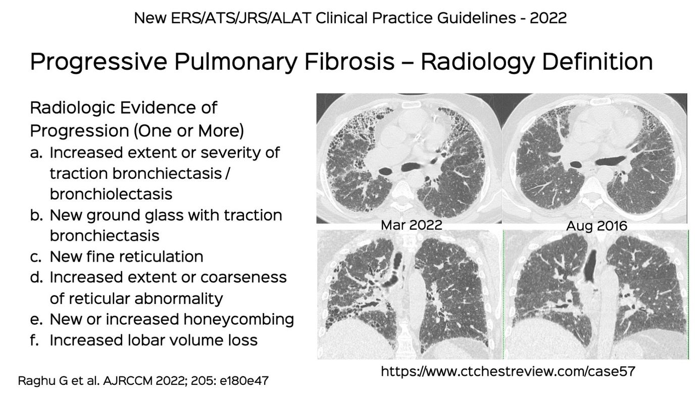 case study pulmonary fibrosis