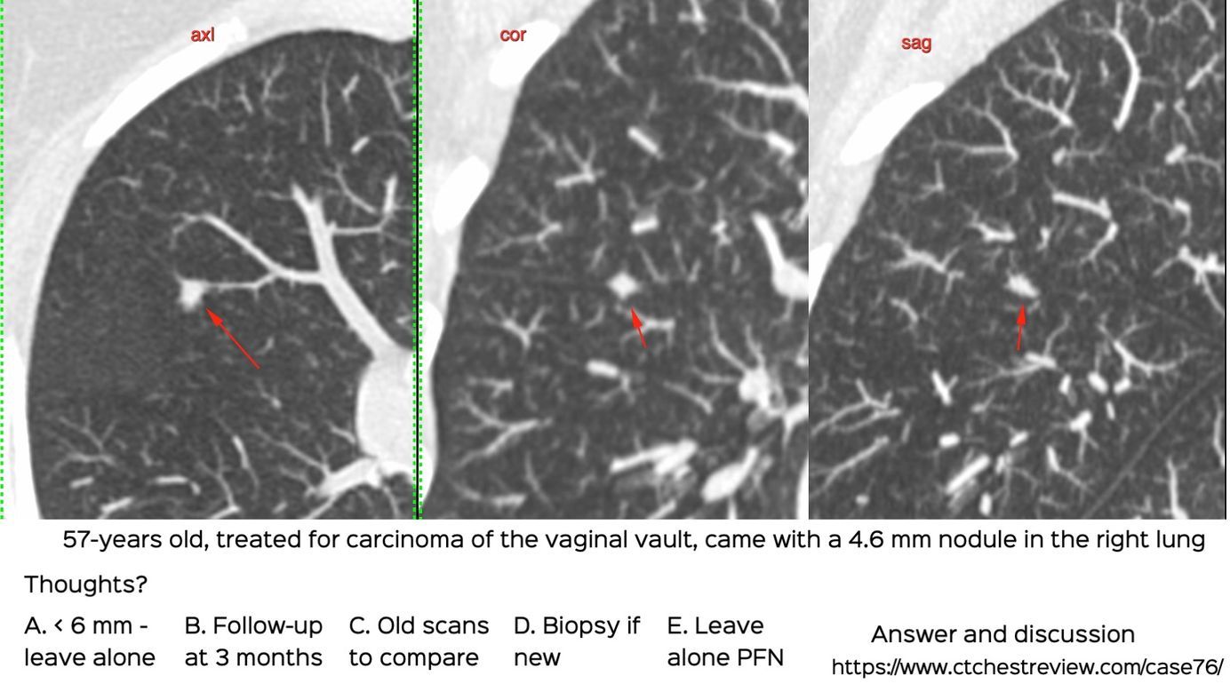 perifissural-nodule-ct-chest-review