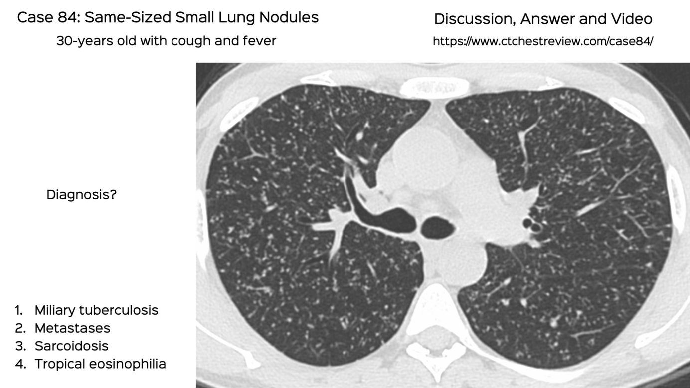 what-you-need-to-know-about-lung-nodules-inspira-health