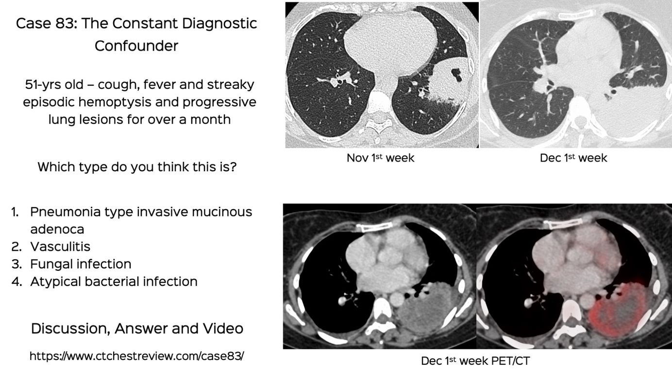 Vasculitis - CT Chest Review