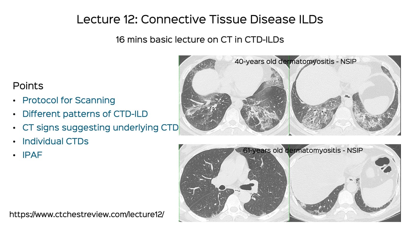 REF-Cafe Roentgen Thoracic Thursday Lecture - I: Fibrosing ILDs - 2023 ...