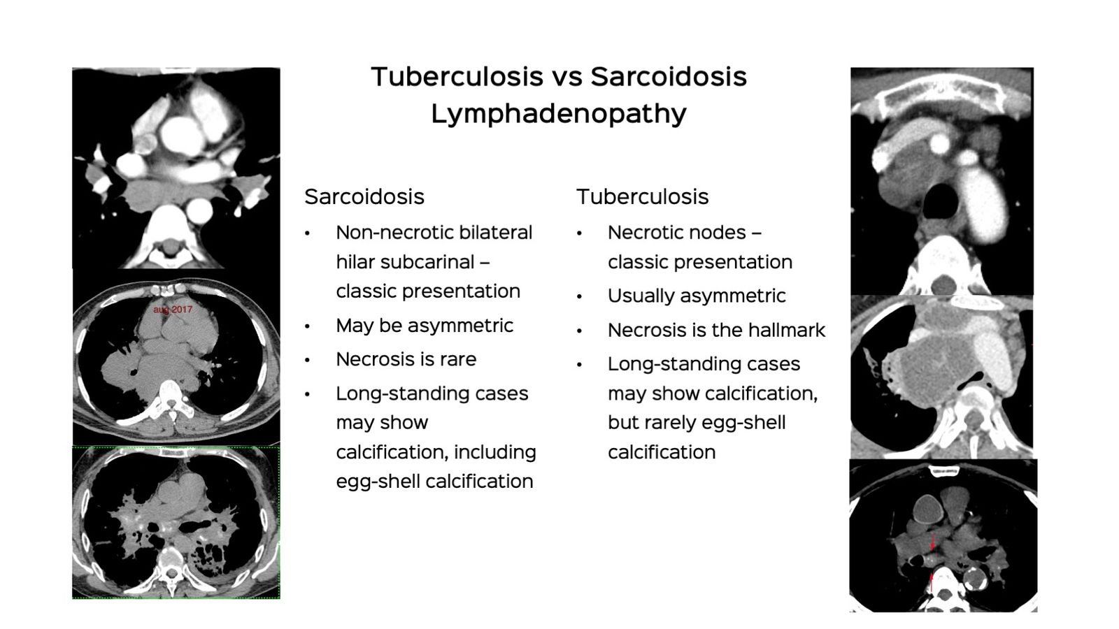 Tuberculosis Vs Sarcoidosis Lecture