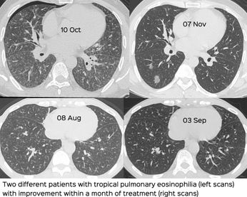 Tropical Pulmonary Eosinophilia - CT Chest Review