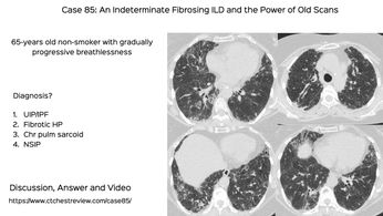 Hypersensitivity Pneumonitis - CT Chest Review