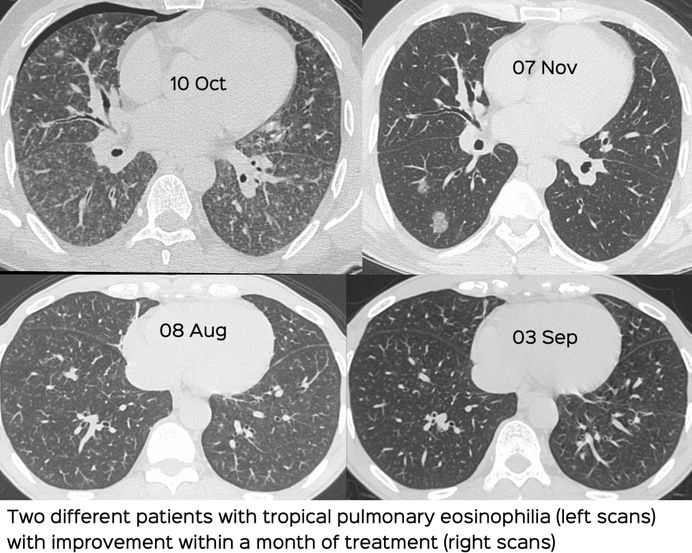 tropical-pulmonary-eosinophilia-ct-chest-review