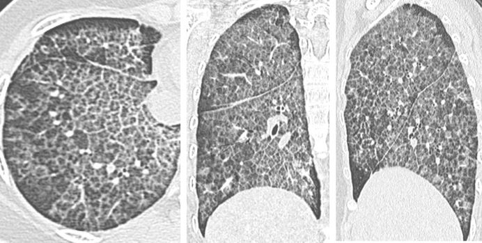 Pulmonary Alveolar Proteinosis Ct Chest Review