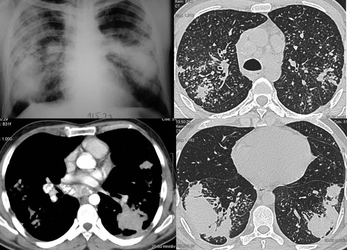 Silicosis Ct Chest Review