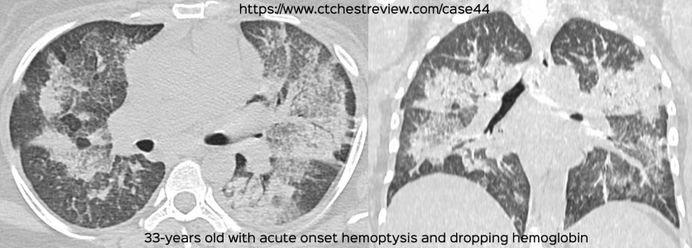 Diffuse Lung Disease - CT Chest Review