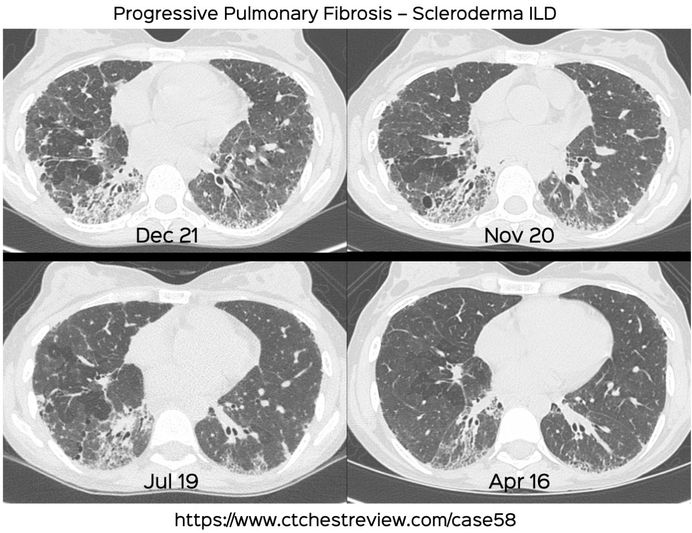 Case 58: Progressive Pulmonary Fibrosis - Scleroderma ILD