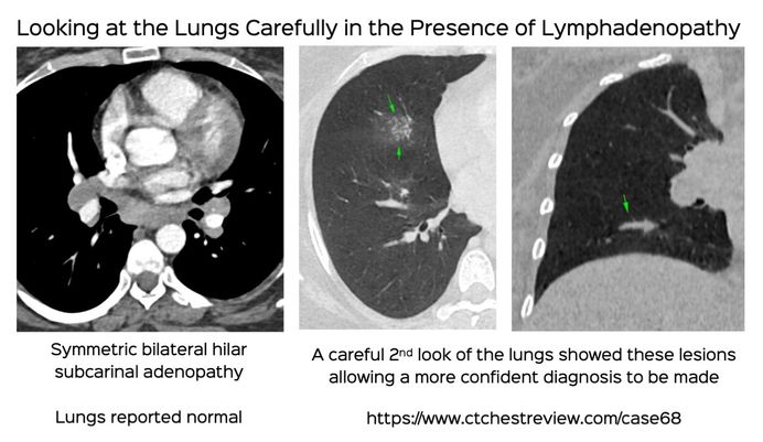 Case 68: Looking at the Lungs Carefully When There is Lymphadenopathy